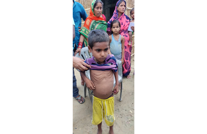 Muzaffarpur children litchi malnourished doctors