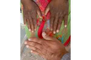 skin pithampur mp pollution climate change